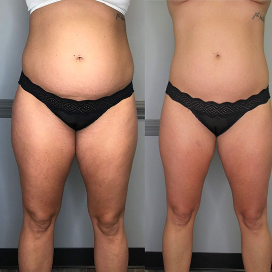 Skin Studio in Ithaca fat freezing body contouring of the belly