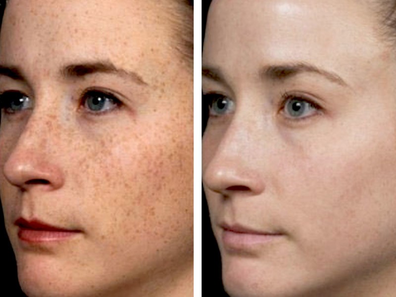 Skin Studio in Ithaca IPL replacement before and after images
