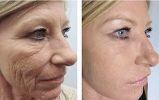 Skin Studio in Ithaca Micro needling before and after images